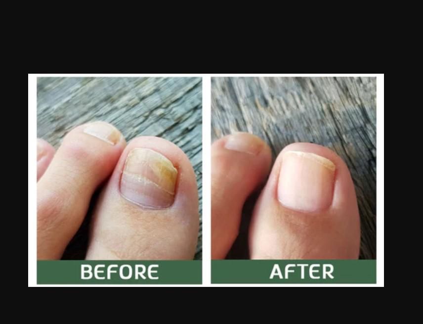 Bee Venom Nail Treatment Serum  [Repair Your Nail]-  Buy 1 Get 1 Free😍