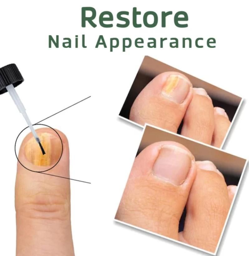 Bee Venom Nail Treatment Serum  [Repair Your Nail]-  Buy 1 Get 1 Free😍